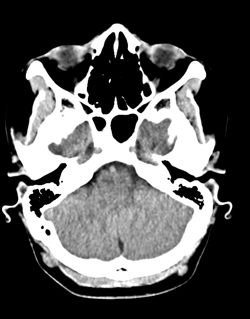 Cerebral abscesses (Radiopaedia 70458-80568 Axial non-contrast 17).jpg