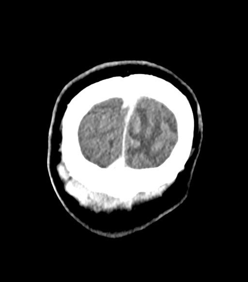 Cerebral abscesses (Radiopaedia 70458-80568 Coronal Contrast 62).jpg