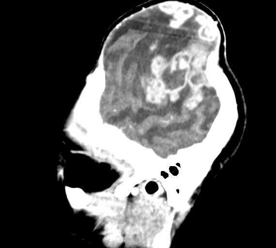 Cerebral abscesses (Radiopaedia 70458-80568 Sagittal Contrast 10).jpg