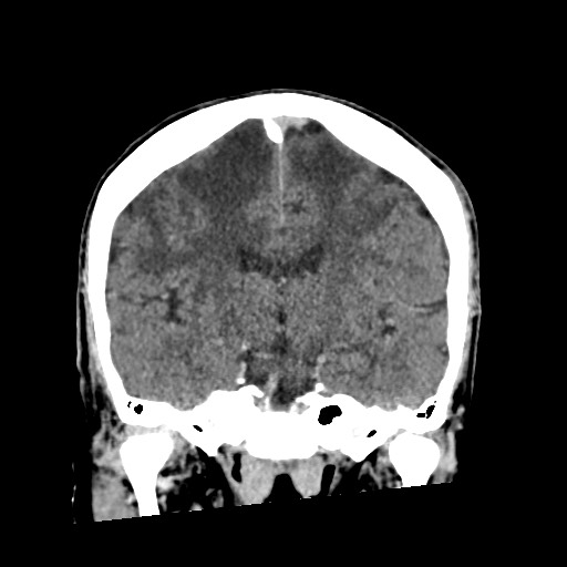 Cerebral amyloid angiopathy-related inflammation (Radiopaedia 74836-85848 Coronal non-contrast 38).jpg