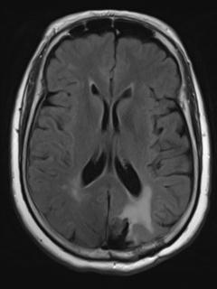 File:Cerebral amyloid angiopathy (Radiopaedia 29129-29518 Axial FLAIR 12).jpg