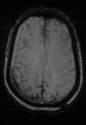 File:Cerebral amyloid angiopathy (Radiopaedia 29129-29518 Axial SWI Magnitude 25).jpg