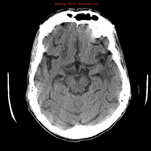 File:Cerebral and orbital tuberculomas (Radiopaedia 13308-13310 Axial non-contrast 30).jpg