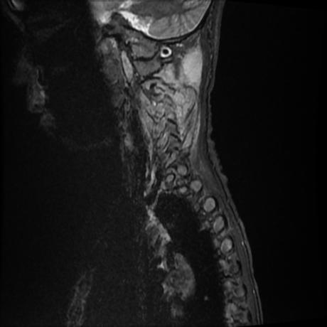 File:Cerebral and spinal tuberculosis (Radiopaedia 90489-107838 Sagittal STIR 12).jpg