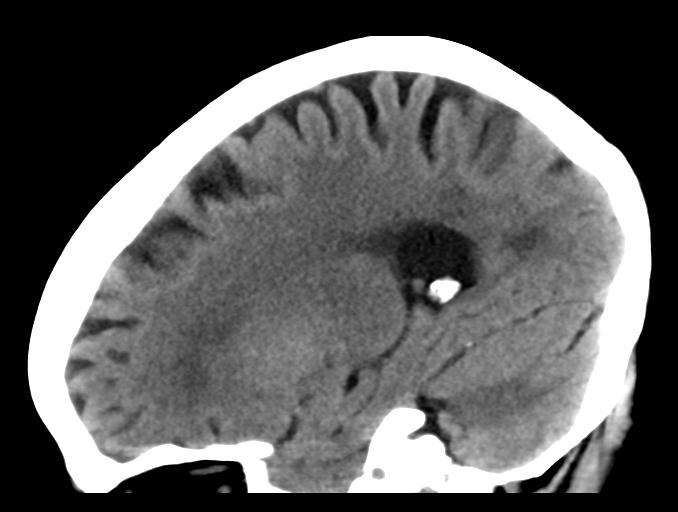 File:Cerebral aneurysm with rupture (Radiopaedia 29933-30457 B 11).jpg