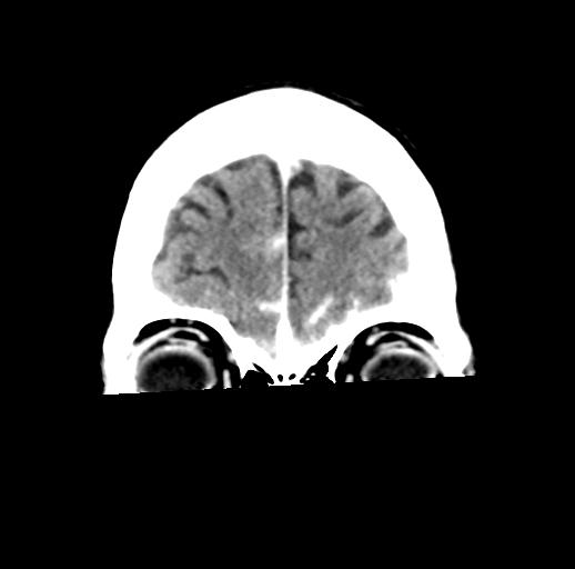 File:Cerebral aneurysm with rupture (Radiopaedia 29933-30460 Coronal non-contrast 6).jpg