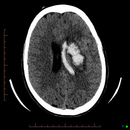 Cerebral arteriovenous malformation (AVM) (Radiopaedia 78162-90706 Axial non-contrast 41).jpg