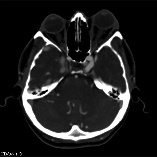 Cerebral arteriovenous malformation (Radiopaedia 28518-28759 B 9).jpg
