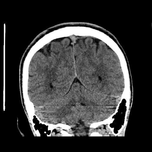 Cerebral arteriovenous malformation (Radiopaedia 61964-70028 Coronal non-contrast 45).jpg