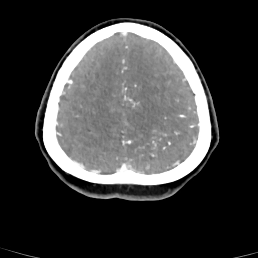 Cerebral arteriovenous malformation (Radiopaedia 73830-84645 B 20).jpg