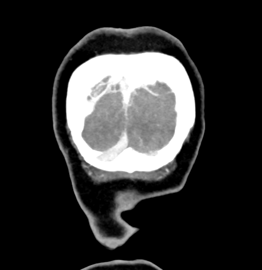 Cerebral arteriovenous malformation (Radiopaedia 73830-84645 C 92).jpg