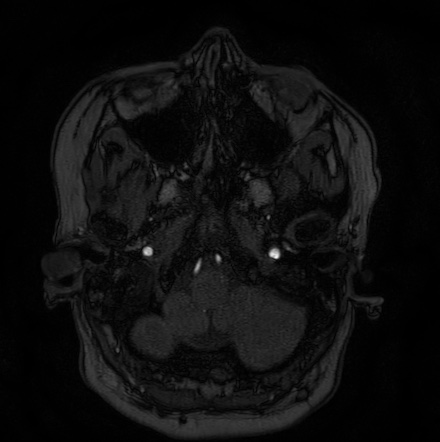 Cerebral arteriovenous malformation (Radiopaedia 74411-85654 Axial MRA 2).jpg