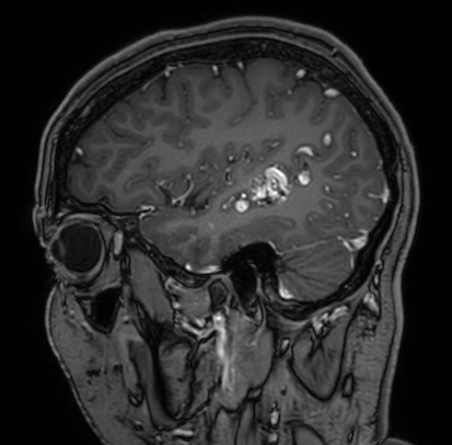 Cerebral arteriovenous malformation (Radiopaedia 74411-85654 Sagittal T1 C+ 27).jpg