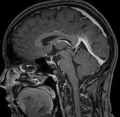Cerebral arteriovenous malformation (Radiopaedia 74411-85654 Sagittal T1 C+ 67).jpg