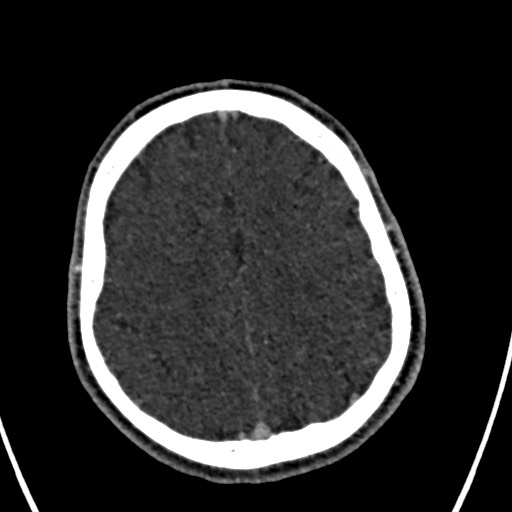 Cerebral arteriovenous malformation (Radiopaedia 78188-90746 Axial C+ delayed 133).jpg