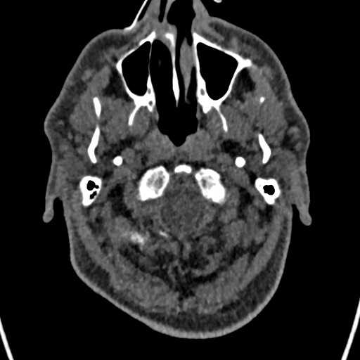 Cerebral arteriovenous malformation (Radiopaedia 78188-90746 Axial non-contrast 10).jpg