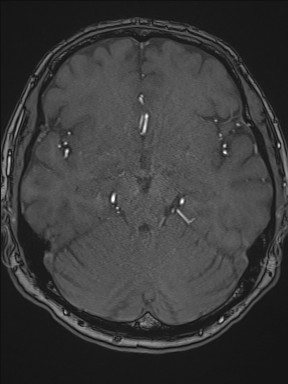 Cerebral arteriovenous malformation (Radiopaedia 84015-99245 Axial TOF 105).jpg