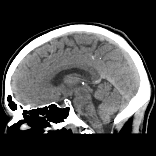 File:Cerebral arteriovenous malformation (Spetzler-Martin grade 2) (Radiopaedia 41262-44076 A 32).png