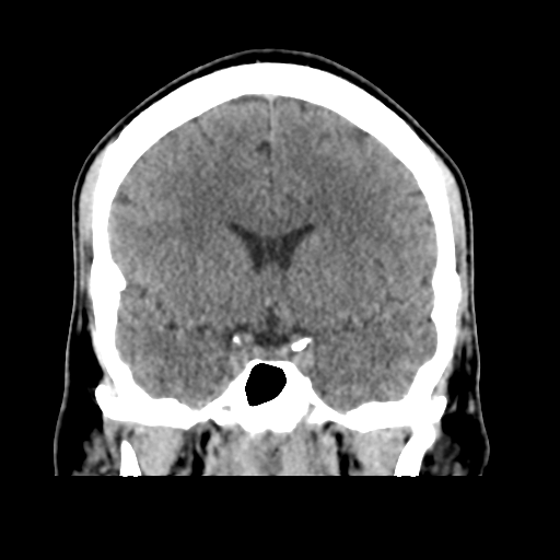 Cerebral arteriovenous malformation (Spetzler-Martin grade 2) (Radiopaedia 41262-44076 Coronal non-contrast 25).png