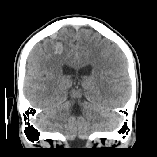File:Cerebral arteriovenous malformation (Spetzler-Martin grade 2) (Radiopaedia 41262-44076 Coronal non-contrast 40).png