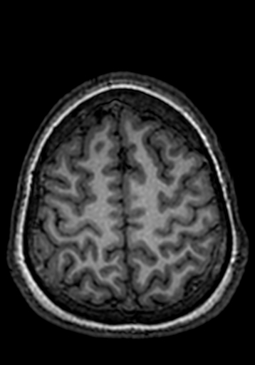 Cerebral arteriovenous malformation at posterior body of corpus callosum (Radiopaedia 74111-84925 Axial T1 44).jpg