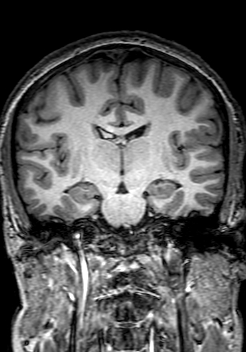 Cerebral arteriovenous malformation at posterior body of corpus callosum (Radiopaedia 74111-84925 Coronal T1 171).jpg