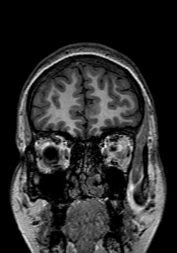 File:Cerebral arteriovenous malformation at posterior body of corpus callosum (Radiopaedia 74111-84925 Coronal T1 32).jpg