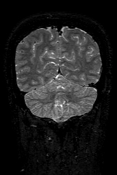 Cerebral arteriovenous malformation at posterior body of corpus callosum (Radiopaedia 74111-84925 Coronal T2 142).jpg