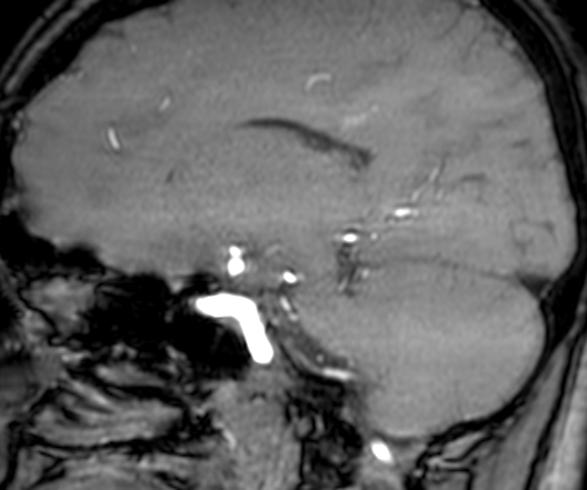 Cerebral arteriovenous malformation at posterior body of corpus callosum (Radiopaedia 74111-84925 J 154).jpg
