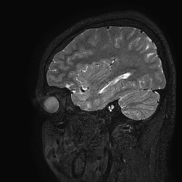Cerebral arteriovenous malformation at posterior body of corpus callosum (Radiopaedia 74111-84925 Sagittal T2 29).jpg