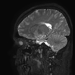 Cerebral arteriovenous malformation at posterior body of corpus callosum (Radiopaedia 74111-84925 Sagittal T2 46).jpg