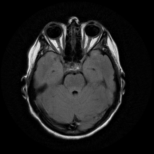 File:Cerebral autosomal dominant arteriopathy with subcortical infarcts and leukoencephalopathy (CADASIL) (Radiopaedia 41018-43763 Ax T2 Flair PROP 7).png