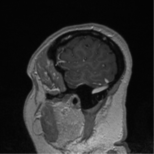 File:Cerebral cavernoma and development venous anomaly (Radiopaedia 37603-39482 Sagittal T1 C+ 15).png