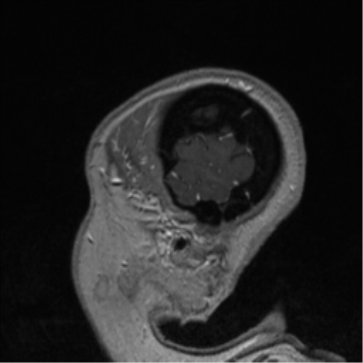 Cerebral cavernoma and development venous anomaly (Radiopaedia 37603-39482 Sagittal T1 C+ 86).png