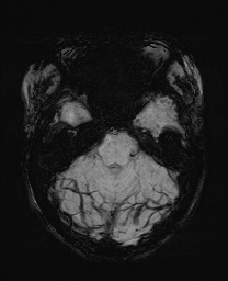 Cerebral cavernous venous malformation (Radiopaedia 70008-80021 Axial SWI 19).jpg