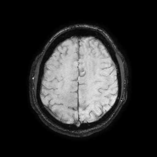 Cerebral cavernous venous malformation (Zabramski type II) (Radiopaedia 85511-101198 Axial SWI 91).jpg