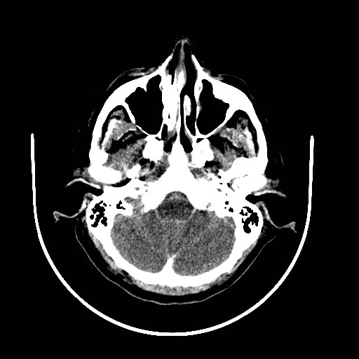 File:Cerebral edema (evolution in time) (Radiopaedia 19418-19439 non-contrast 16).jpg