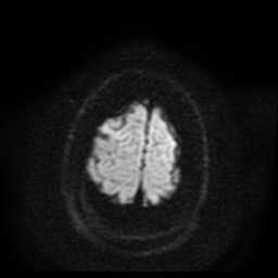 File:Cerebral embolic infarcts (embolic shower) (Radiopaedia 49837-55108 Axial DWI 53).jpg