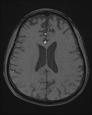 Cerebral embolic infarcts (embolic shower) (Radiopaedia 72391-82921 Axial MRA 127).jpg
