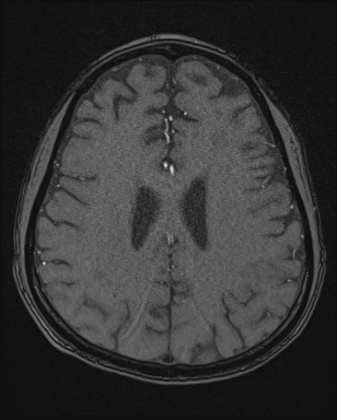 Cerebral embolic infarcts (embolic shower) (Radiopaedia 72391-82921 Axial MRA 136).jpg