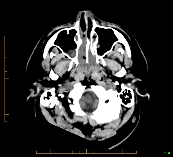 Cerebral fat embolism (Radiopaedia 85521-101224 Axial non-contrast 5).jpg