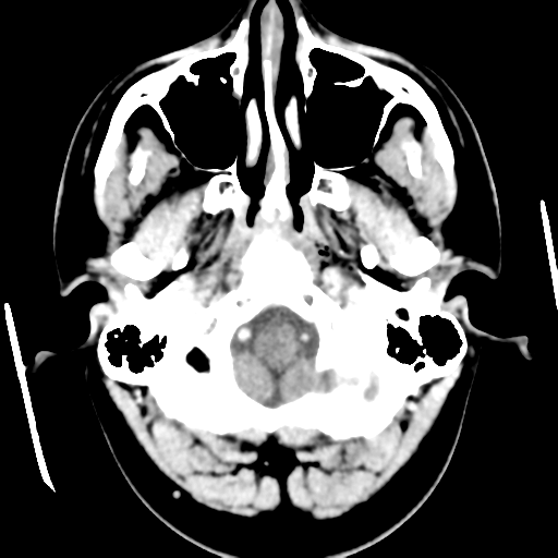 Cerebral hemorrhage secondary to arteriovenous malformation (Radiopaedia 33497-34561 B 8).png