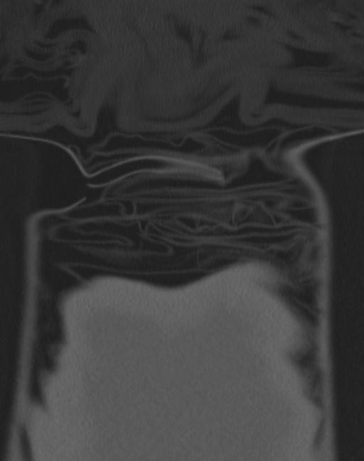 Cerebral hemorrhagic contusions and cervical spine fractures (Radiopaedia 32865-33841 Coronal bone window 107).jpg