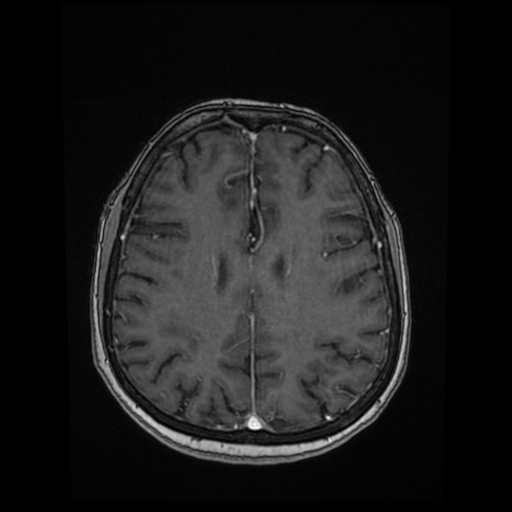 Cerebral metastases - melanoma (Radiopaedia 80972-94522 Axial T1 C+ 66).jpg