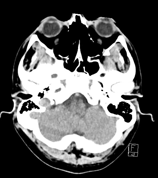 Cerebral metastases - testicular choriocarcinoma (Radiopaedia 84486-99855 Axial non-contrast 45).jpg