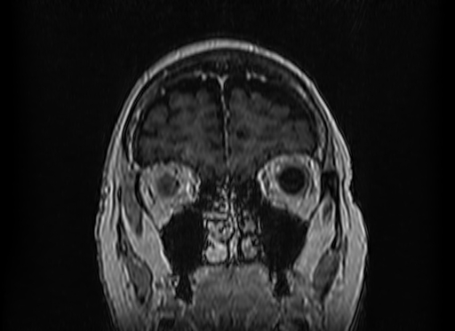 Cerebral metastases from lung cancer with amyloid angiopathy and cerebellopontine angle meningioma (Radiopaedia 74306-85191 Coronal T1 C+ 8).jpg