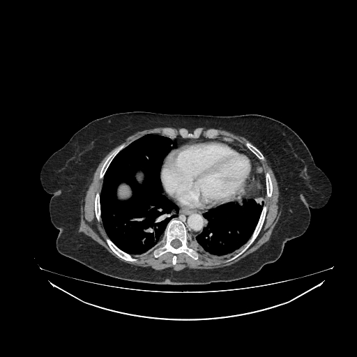 Cerebral metastases from lung cancer with amyloid angiopathy and cerebellopontine angle meningioma (Radiopaedia 74306-85223 A 30).jpg