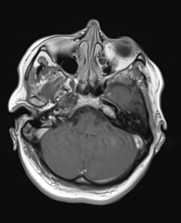 File:Cerebral metastases mimicking abscesses (Radiopaedia 45841-50131 Axial T1 C+ fat sat 7).png