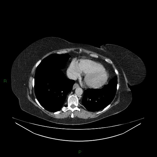 Cerebral metastasis from renal cell carcinoma (Radiopaedia 82306-96378 A 11).jpg