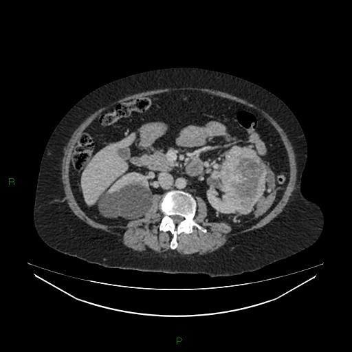 Cerebral metastasis from renal cell carcinoma (Radiopaedia 82306-96378 A 79).jpg